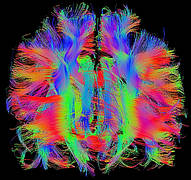 MRI picture from the brain